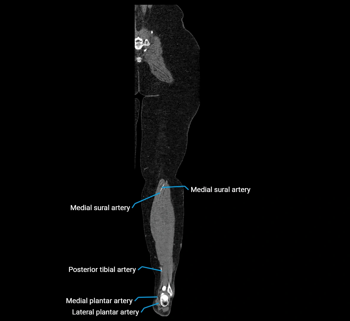 CTA lower limb coronal cross sectional anatomy labelled image _77 (2).webp